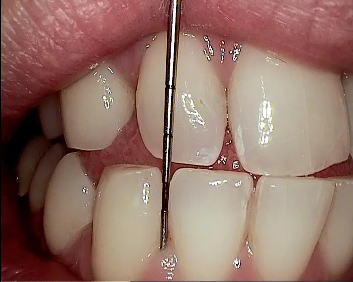 A periodontal probe that is used to measure the depth of the space between the gum and the tooth to measure for bone loss/tissue loss. 