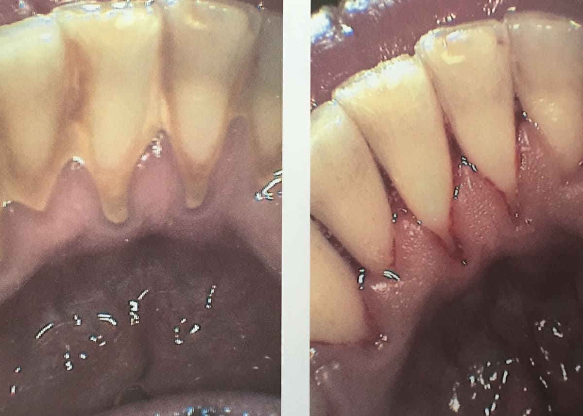 Before and after a dental hygiene cleaning appointment. All of the tartar (calculus) has been removed and will facilitate healing of the tissues surrounding the teeth.  
