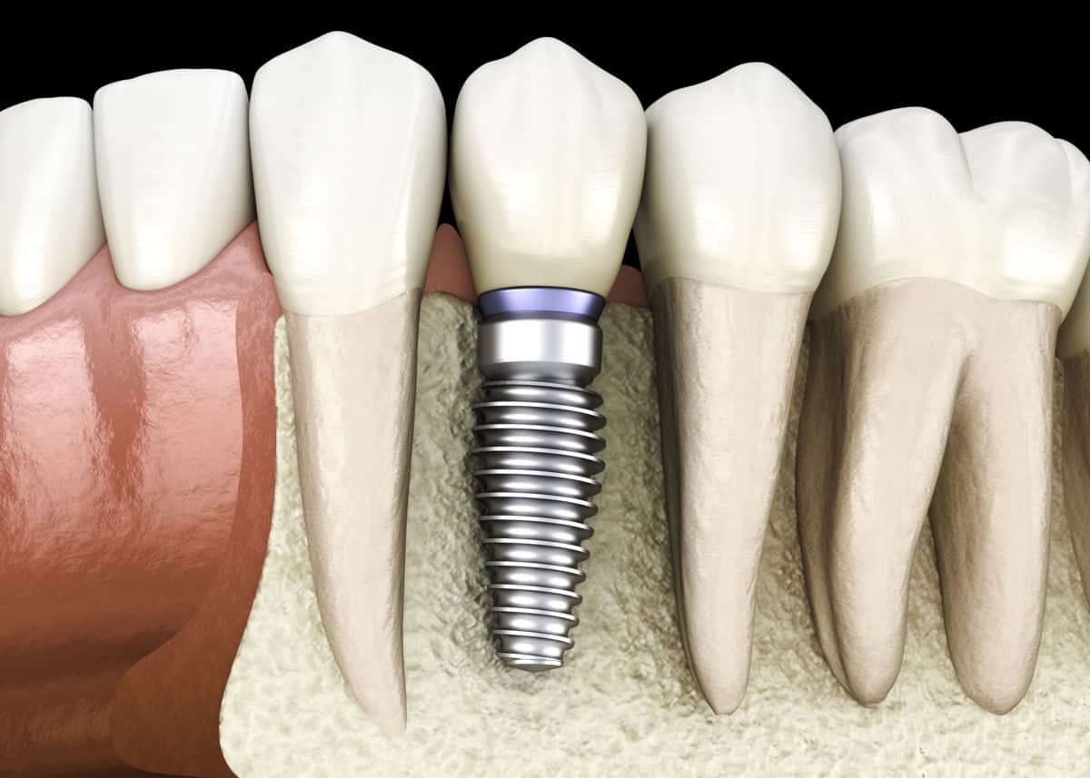 Premolar tooth recovery with implant. Medically accurate 3D illustration of human teeth and dentures concept