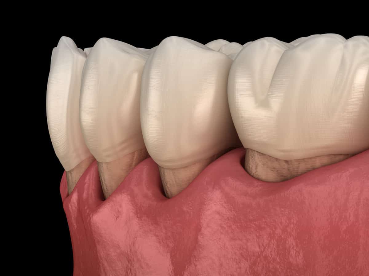 Photo of: Gum recession process. Medically accurate 3D illustration