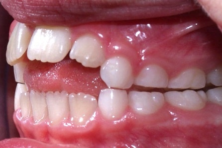 Example of what can happen to front teeth from tongue thrust and thumb sucking. 