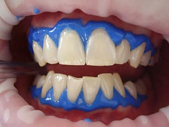Teeth whitening barrier on hum tissue to prevent gum irritation or burning