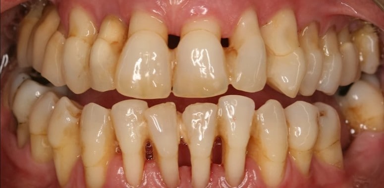 Gum disease has caused bone loss, and the gums have receded. The roots of the teeth are visible. 