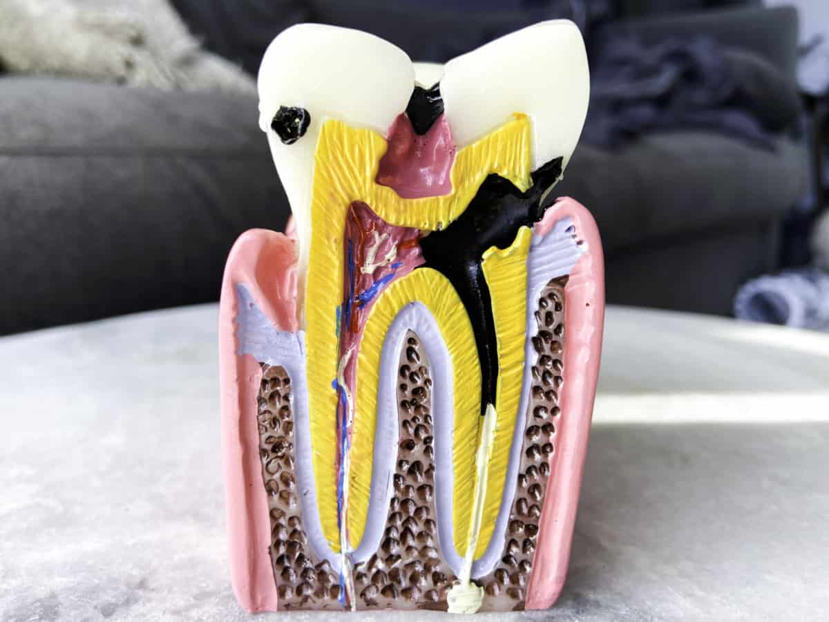 Bone Loss and decay cross section of tooth