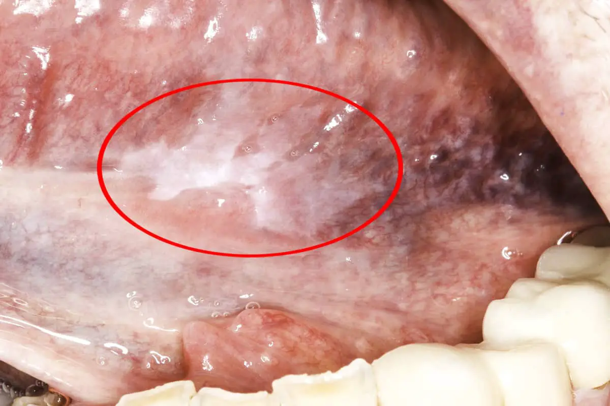 Leukoplakia on the underside of the tongue. Border is irregular in shape, and it cannot be wiped off. 