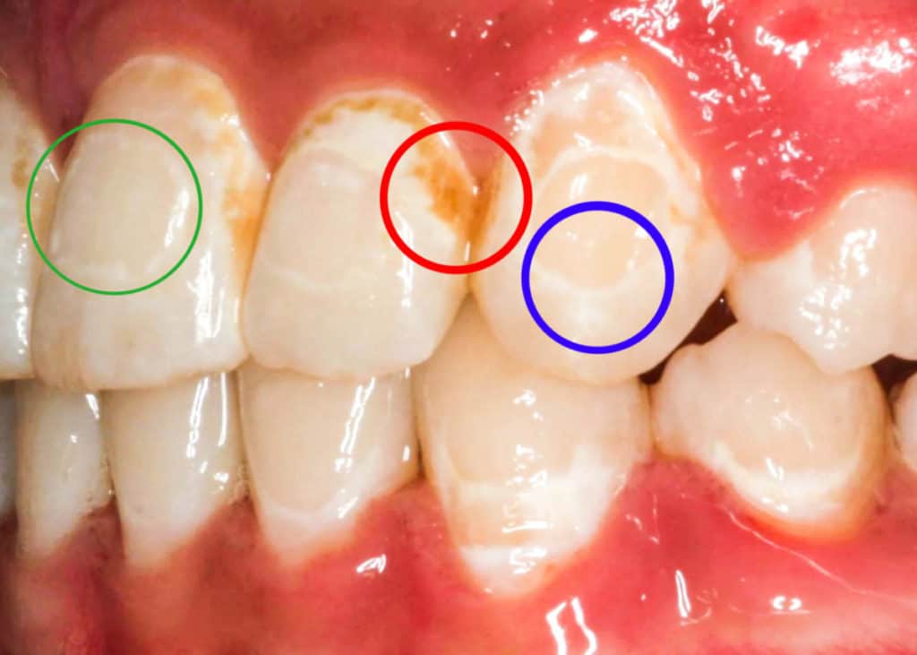 White Spots from Braces; Are They Permanent? Tooth Be Told