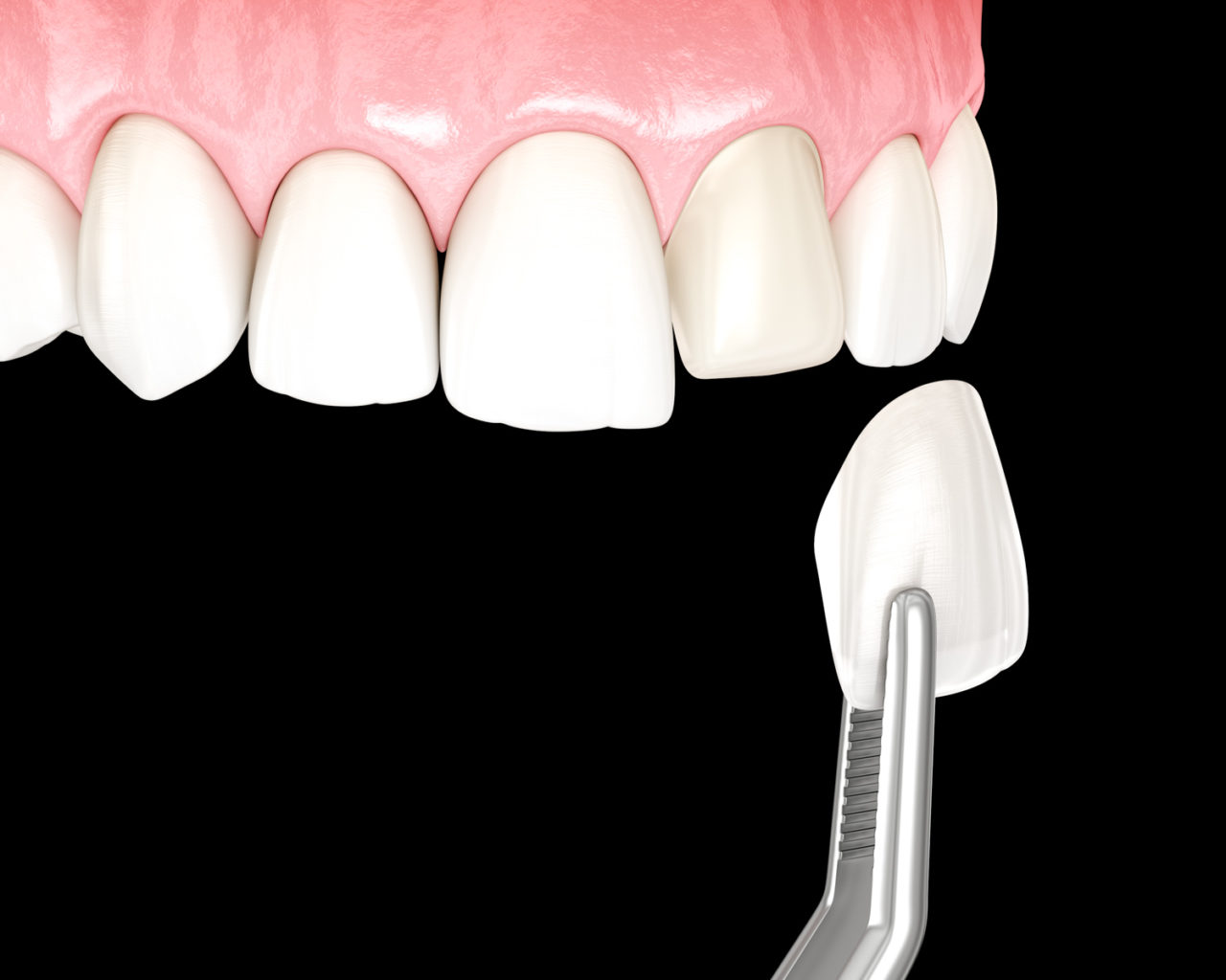 Veneer installation procedure over central incisor. Medically accurate tooth 3D illustration