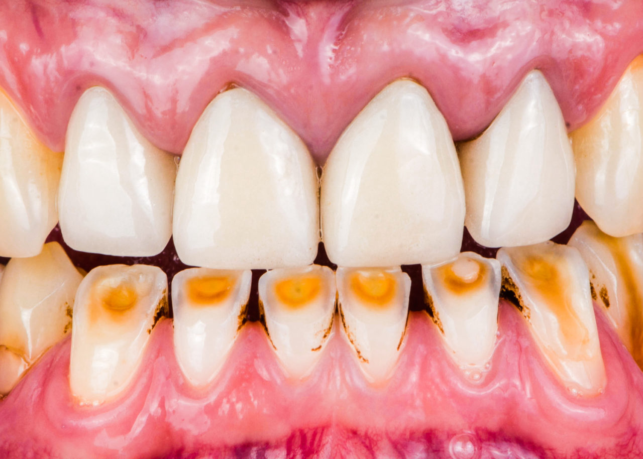 the dental ceramic crowns with opposed worn teeth