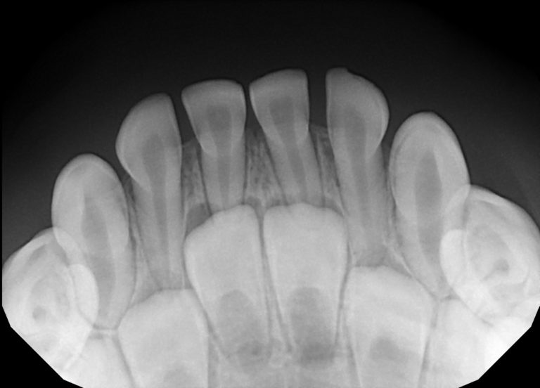 radiograph of mandibular anteriors. baby teeth with adult teeth underneath. 