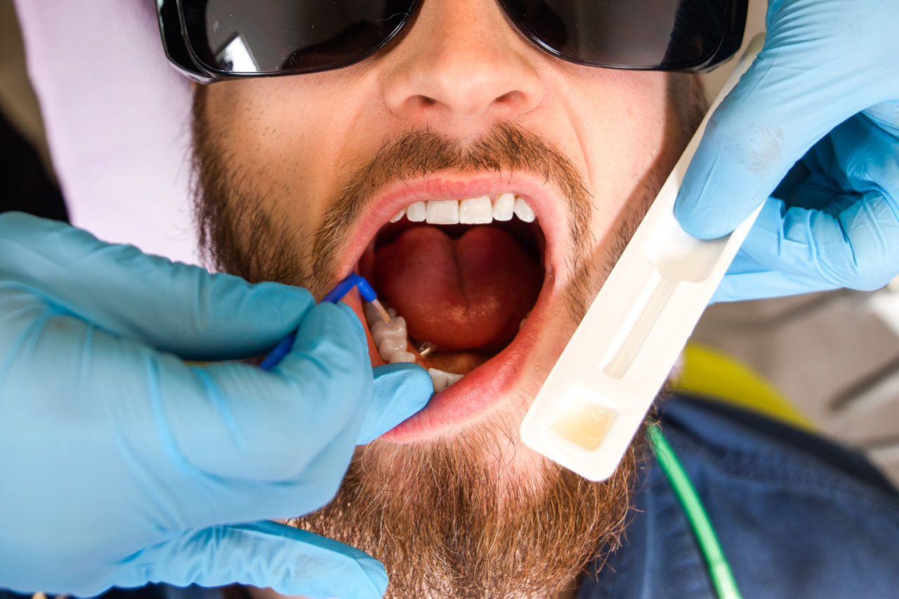 A dental hygienist applies fluoride varnish to desensitize the teeth and prevent tooth decay. 