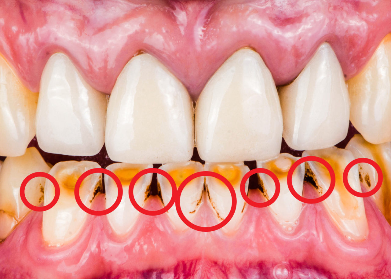 Extrinsic tooth stain shown within red circles on mandibular teeth. 