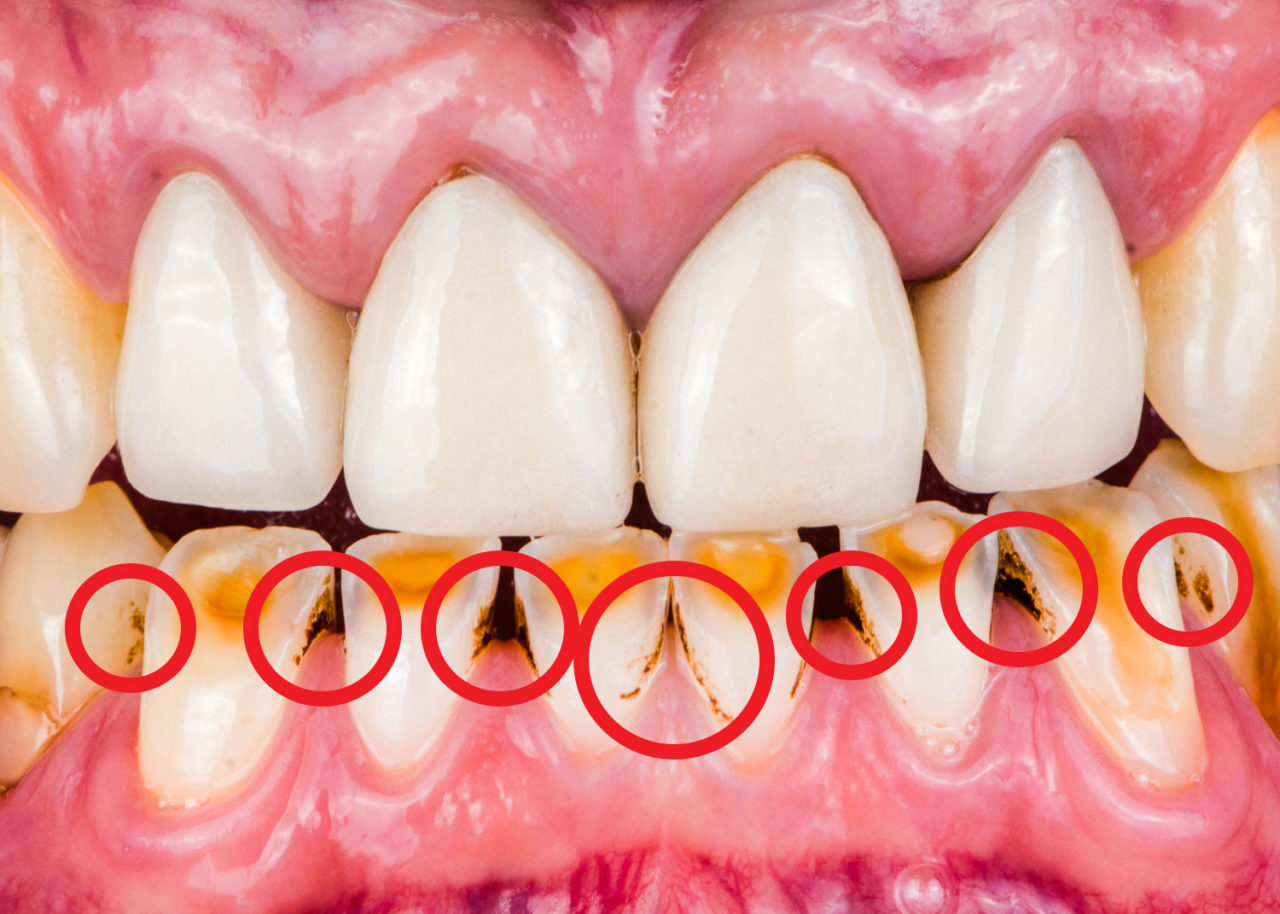 Extrinsic tooth stain shown within red circles on mandibular teeth.