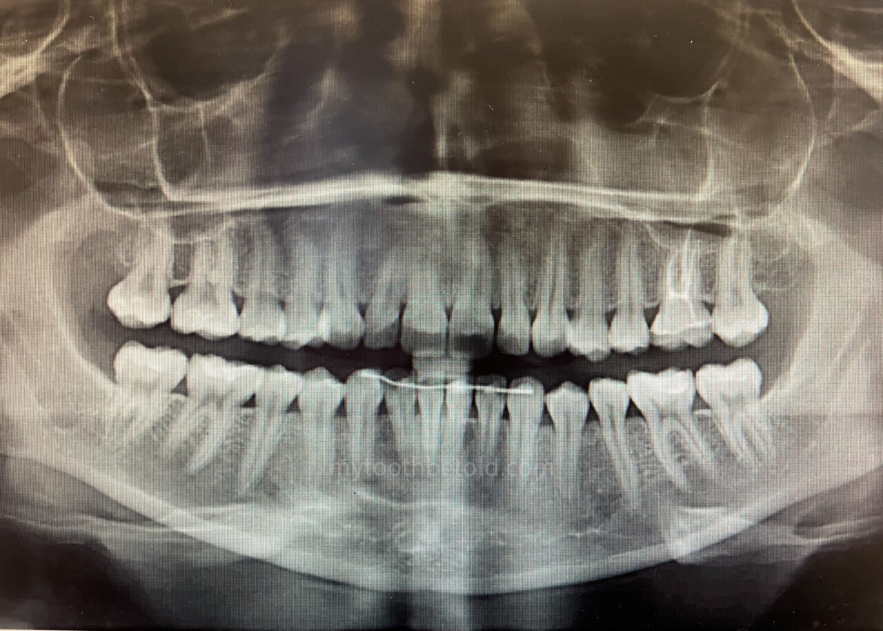 A portion of a panorex (panoramic) x-ray was taken at the dental office. 
